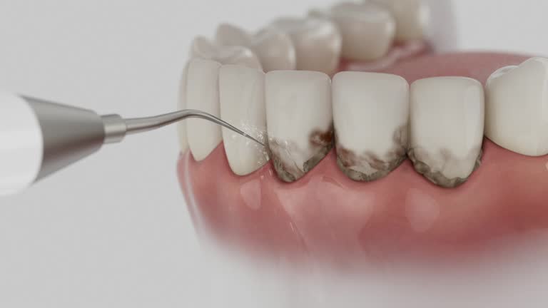 Trusted Wisdom Tooth Removal service in Coldstream, KY - Dentist Open Now